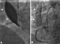 (A) Coronary angiography showing total obstruction of the right coronary artery (RCA) lumen with contrast media retention within the false lumen of the ascending aorta (arrowheads) indicative of the retrograde propagation of the RCA ostium dissection. (B) Stenting of the RCA ostium restored flow in the RCA and patient hemodynamic stability; staining of the ascending aorta wall by contrast is shown (arrowheads).