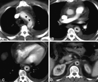 Contrast-enhanced computed tomography images demonstrate the border (arrowheads) between the true and false lumen of the dissected aortic arch (A), descending thoracic aorta (B and C) and abdominal aorta (D) at the level of the right kidney (RK) and the ostium of the right renal artery.