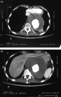 CT scan demonstrates huge thoraco-abdominal aneurysm with compression of the stomach and the heart (a) and erosion of a vertebral body (b).