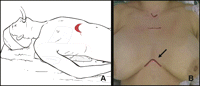(A and B) Patient’s position. (A) The patient is supine with the arms resting along the body and the head hyperextended. (B) The cutaneous incision is horizontal, with a length of 5–6 cm, lightly upward curvilinear, 4–5 cm above the xyphoid (arrow).