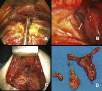 (A–D) Intraoperative pictures.