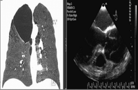 Frontal thorax CT view of lung and TEE image show dilated aortic root and dissection.