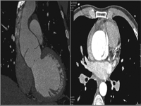 Multislice CT image, ascending aorta dilatation and dissection.