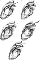 (a) Angulation of the RITA on the intermediate branch is not perpendicular; (b) proximal T anastomoses on the LITA, (c) use of a second small Y-graft; (d) proximal composite anastomosis of a free RITA on the LITA very high on the LITA and (e) latero-lateral anastomosis on the intermediate branch.