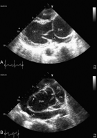 (A) In transthoracic echocardiography, the parasternal long axis view shows a cystic mass, a noncoronary sinus of Valsalva aneurysm, compressing the left atrium. (B) In the parasternal short axis view, the noncoronary sinus of Valsalva is aneurysmatic and a flap-like appearance (white arrow) can easily be seen. LV, left ventricle; LA, left atrium; RV, right ventricle; SVA, sinus of Valsalva aneurysm; NCC, noncoronary cusp; RCC, right coronary cusp; LCC, left coronary cusp; PV, pulmonary valve; PA, pulmonary artery.