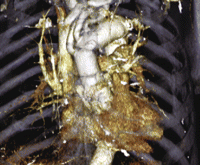 Postoperative CT demonstrating T-shaped reconstruction of pulmonary artery and total arch replacement.