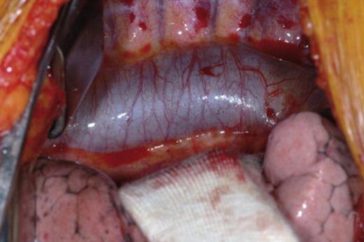 intraoperative view showing impressive dilatation of azygos vein secondary to absence of the inferior vena cava