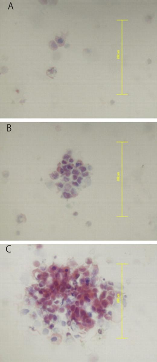 Classification of isolated tumor cells by cluster formation. Shown are results following Papanicolaou staining. (A) Arrows indicate singular cancer cells. (B) Clustered cancer cells (≤0.2 mm). (C) Bulky clustered cells (>0.2 mm). Original magnification ×40. Scale bars = 0.2 mm.