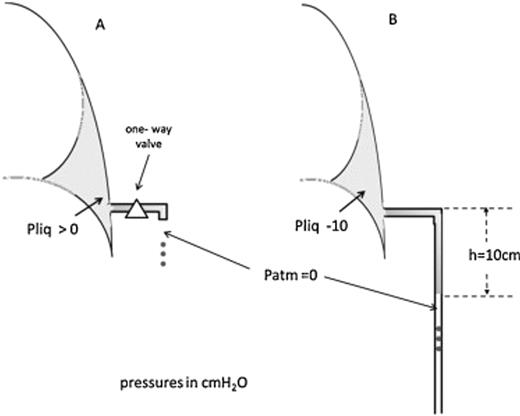 (A) A ‘passive’ drainage set up: pleural liquid pressure is above atmospheric. (B) An ‘active’ drainage is generated when fluid proceeds downward the tube and a subatmospheric pressure is applied to the pleural liquid.