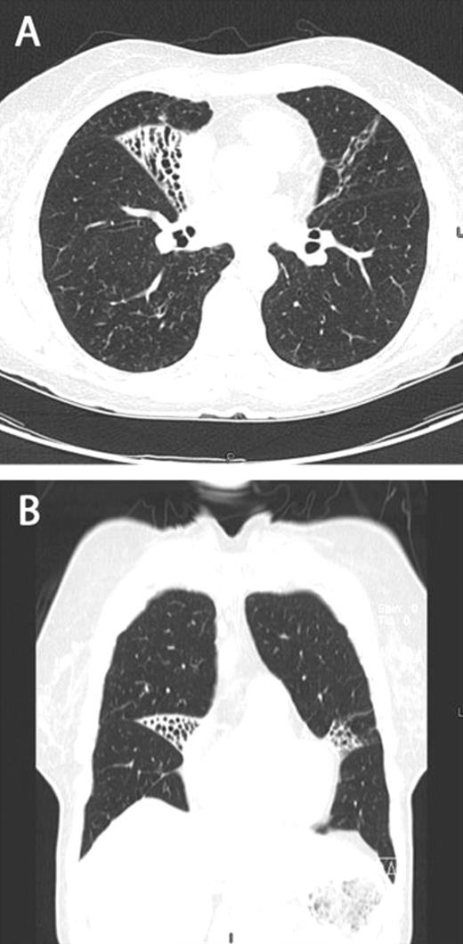 Axial (A) and coronal (B) computed tomography images demonstrating focal bronchiectasis in both the right middle lobe and lingula, characteristic of Lady Windermere syndrome.