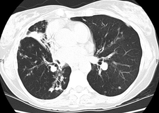 Computed tomography image demonstrating isolated bronchiectasis in the right middle lobe with associated inflammatory changes in the superior segment of the right lower lobe.