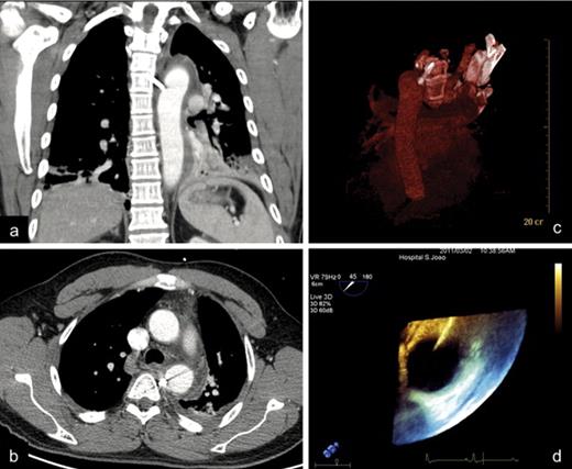 CT image revealed a peri-aortic hematoma, minimal left pleural effusion, and a 3 cm-long linear metallic foreign body in tight contact with the descending aorta (a)–(c). However, because of image artifacts, aortic wall integrity could not be ensured. Transesophageal echography unequivocally showed that one of the tips of the foreign body was inside the lumen of the vessel (d).
