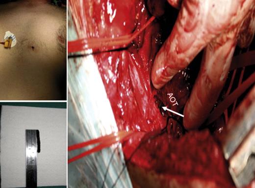 A postero-lateral thoracotomy was performed with removal of the object (arrow) and repair of the aortic wall perforation. The patient did not identify the piece as belonging to the bush cutter. AOT – thoracic descending aorta.