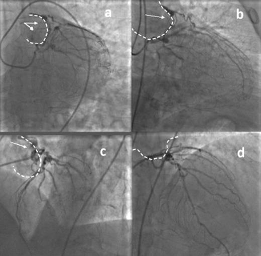 Left coronary angiography showing left coronary to pulmonary artery fistula, connecting left main to diagonal branch, draining with two dye-jets (white arrows) into pulmonary artery (dashed line), distal aneurysm of left main, severe stenosis on left anterior descending and marginal branch, occlusion of left circumflex and collateral circulation for right coronary. (a) Caudal view, (b) right caudal view, (c) left view and (d) right cranial view.
