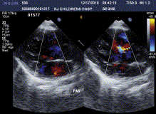 The representative echocardiogram of patients before operation.