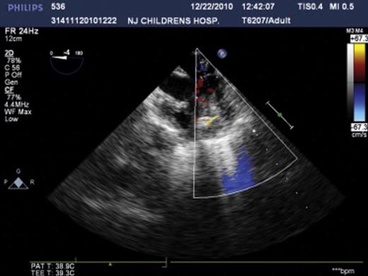 The representative echocardiogram of patients during operation.