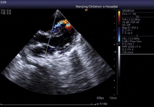 The representative echocardiogram of patients after operation.