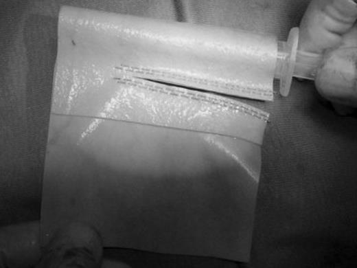 Construction of the pericardial tube. Longitudinal suture is performed by applying the linear reloadable stapler to the leaflet wrapped around a syringe.