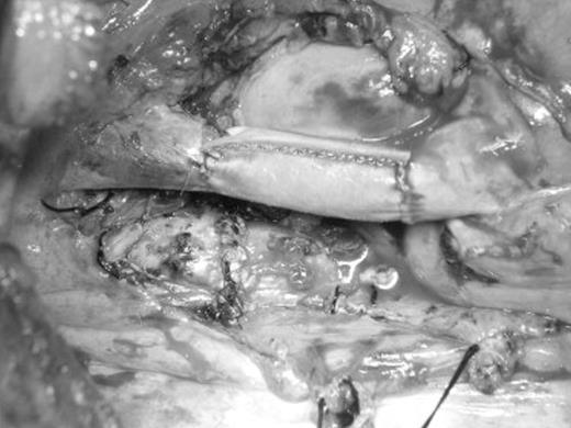 Intraoperative view of SVC reconstruction with bovine pericardial conduit after sleeve pneumonectomy through a right lateral thoracotomy.