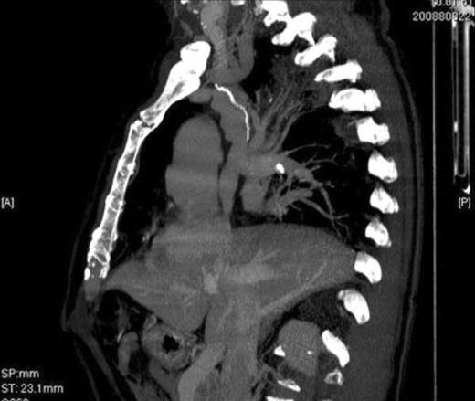 One-year postoperative computed tomography image with injection of contrast material showing excellent alignment and patency of the stapled SVC prosthesis.