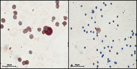 (A) 63 × Double staining for CK and CXCR4 show coexpression of both antigens in an single CTC; (B) 40× a single cell with brown staining for CK and negative staining for CXCR4; (C) graph with relative proportion of cases with CTC expressing CK and with CTC expressing only CK.