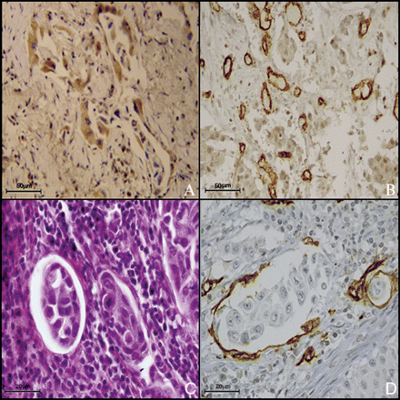A case of adenocarcinoma with high expression of CXCR4 (A, 40×) and high MVD (B, 20×). Neoplastic clot in a vessel (C, H&E40×) and neoplastic clot covered in endothelial cell in a vessel (D, CD31 immunostaining, 63×).