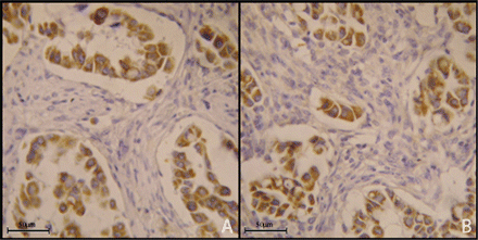 A case of adenocarcinoma expressing CXCR4 (A, 40×) and CXCR7 (B, 40×).