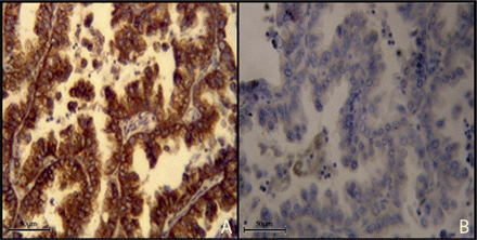 Adenocarcinoma with high expression (A, 40×) and low expression of CXCR4 (B, 40×).