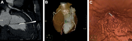 (A) Preoperative 64-slice computed tomography scans revealed a nail penetrating into the left ventricle with suspicion of coronary artery involvement; (B) the nail was totally buried in the chest wall. (C) Three-dimensional reconstruction of the coronary artery (LAD) with walk-through motion pictures (not shown in this figure).