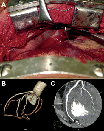 (A) A nail hooked into the chest wall with coronary artery penetration; 160 ml bloody pericardial effusion was sucked out. (B) and (C) Postoperative 64-slice computed tomography scans with three-dimensional reconstruction of the coronary artery showed no stenosis of LAD.
