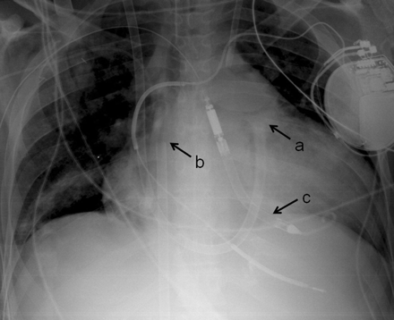 Percutaneous CentriMag right-ventricular assist device with Impella LP 5.0 left ventricular assist device. (a) Tip of outflow cannula in distal main pulmonary artery, (b) tip of inflow cannula in the right atrium, (c) Impella LP 5.0 left ventricular assist device placed tough the right axillary artery.