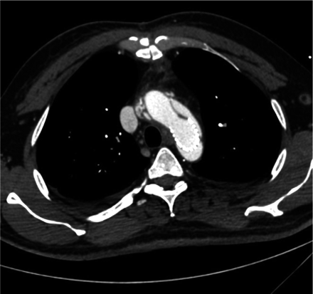 Remaining antegrade perfusion-axial view.