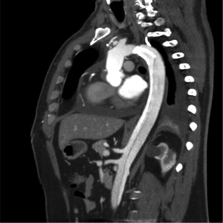 Remaining antegrade perfusion-sagittal view.