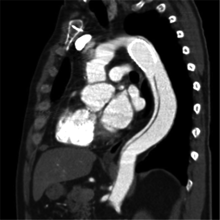 Membrane rupture at the distal end of the stent-sagittal view.