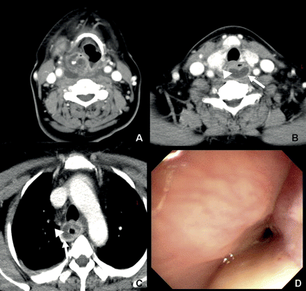 (A) Axial CT of the neck revealed a deep neck infection. (B and C) Chest CT revealed circumferential thickening of the esophageal wall (arrow) with an intramural lower density lesion (arrowhead). (D) Endoscopy revealed diffuse luminal narrowing with poor distensibility at the upper esophagus.