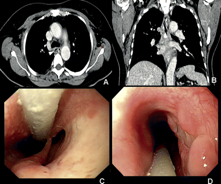 (A and B) Axial and coronary chest CT demonstrated an esophageal intramural dissection (arrowhead) after NG tube exchange. (C) Endoscopy revealed an esophageal double lumen, compatible with esophageal intramural dissection. (D) Repeat endoscopy 3 months later showed a well-healed dissection lumen.