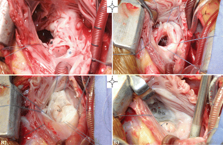 (A) The operative view from the right atrium (case 1) showing the right AV valve (1), the left AV valve (2) and the ventricular septal crest (*) between the two. The lower rim (@) of the posteriorly deviated atrial septum has been retracted to show the restrictive primum ASD (3) which was in proximity to the posterior rim (#) of the left AV valve. (B1) Operative view from right atrium (case 3) showing the two components (V1 and V2) of the right AV valve and an intact ventricular septum; V1 opens into the mildly hypoplastic RV; V2 (∼40% of the right AV valve) opens into the LV establishing a right atrium-to-left ventricle communication; (B2) demonstrates a competent V2 after saline injection of the LV; (B3) shows appearance of V1 (∼60% of the right AV valve) after patch closure (P) of V2. The mitral valve (not shown) opened separately into the left ventricle so that three distinct AV valves were present at the AV junction. Picture orientation: F: foot; H: head; L: left; R: right.