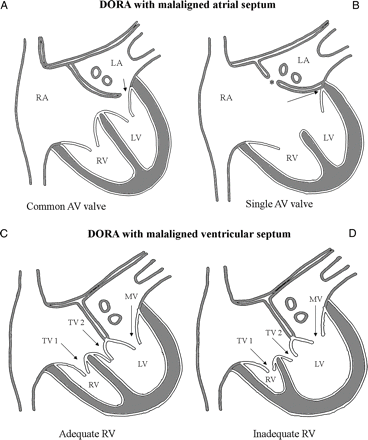 (Upper panel) Leftward rotation of the atrial septum results in DORA with the malaligned atrial septum. Two subtypes are described: one with a common AV junction (guarded by a common AV valve) shown in (A), and the other with a single AV junction (due to the absence of the left AV junction) shown in (B). A restrictive primum ASD (arrow, A) is usually present in the first subtype. An interatrial communication (asterisk, B) decompresses the LA in the second subtype. (Lower panel) Rightward deviation of the intact ventricular septum results in DORA with the malaligned ventricular septum. Two subtypes result depending on the adequacy of the RV for biventricular repair. In the first subtype (C), the RV is adequate (though mildly hypoplastic) for biventricular repair. In the second subtype (D), the RV is inadequate (from severe hypoplasia) and only a single ventricle or one-and-half ventricle repair is possible. LA: left atrium; LV: left ventricle; MV: mitral valve; RA: right atrium; RV: right ventricle; TV: tricuspid valve.