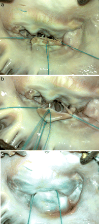 (a) A healthy secondary chorda is cut beneath the P2 scallop to be transferred to the free margin of the elongated part. Note the stay suture at each side of the elongated part of P2. (Note that a white subject like catheter is visible inside the left ventricle in (a) and (b) is the flashing of another secondary chorda while taking the photograph.) (b) The secondary chorda is sutured to the free margin with three interrupted 5-0 polyester sutures. (c) Following completion of the repair, the left ventricle is filled with water and no leaks are observed.