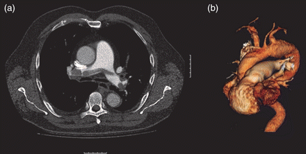 (a) Preoperative CT scan showing a large saddle pulmonary embolus. (b) Three-dimensional reconstruction of preoperative CT scan showing ascending, arch and proximal descending aortic aneurysm.