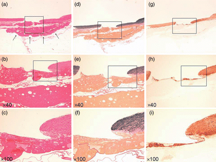 Specimen injured vessel with fresh TC. (a–c) Haematoxylin–eosin stain (arrow: TC). (d–f) EVG stain. (g–i) α-SMA stain. (a, d and g) Loupe. (b, e and h) ×40 Magnification. (c, f and i) ×100 Magnification.