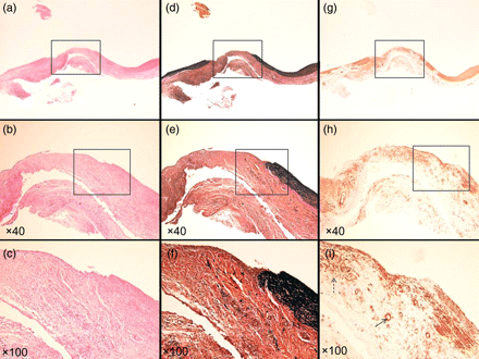Specimen at 2 weeks. (a–c) Haematoxylin–eosin stain. (d–f) EVG stain. (g–i) α-SMA stain. (a, d and g) Loupe. (b, e and h) ×40 Magnification. (c, f and i) ×100 Magnification. Inflammatory cells gathered around the vascular defect and vascular endothelium had already been regenerated on the innermost surface of TC (c). Many neovascular vessels (arrow) and myofibroblastic cells (dotted arrow) can be seen in the vascular defect (i).