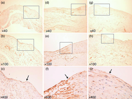 Specimen of VEGF staining. (a–c) At 2 weeks. (d–f) At 4 weeks. (g–i) At 8 weeks. (Arrow: border of TC and the intima.) (a, d and g) ×40 Magnification. (b, e and h) ×100 Magnification. (c, f and i) ×400 Magnification. Endothelial cells strongly expressed VEGF at 2 and 4 weeks.