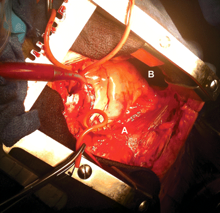 Intra-operative view. Right pericardium (A). Congenital absence of the left pericardium (prevalence between 1 in 10 000 and 1 in 14 000) (B). Notice the rotation of the heart to the left pleural cavity.