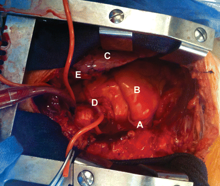 Intra-operative view. Right pericardium (A). Right ventricle (B). Left lung (C). Complete absence of the left pericardium. Aortovenous bypass (grafted onto two obtuse marginal artery branches and on the posterior descending artery) (D). Left internal thoracic artery (grafted on the LAD) (E).