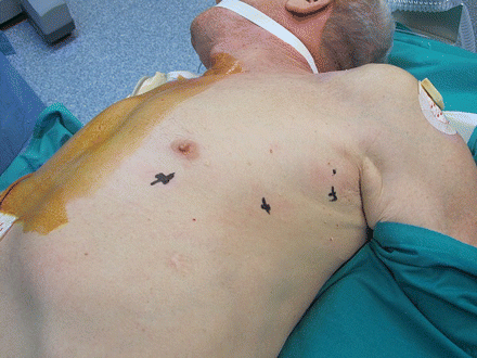 Patient position (30° left side up) with port mapping.