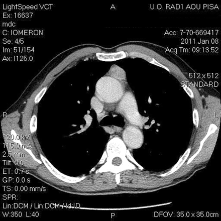 CT imaging of a 59-year old man, with a suspected well-capsulated thymoma.