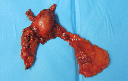 The specimen obtained after robotic thymectomy.