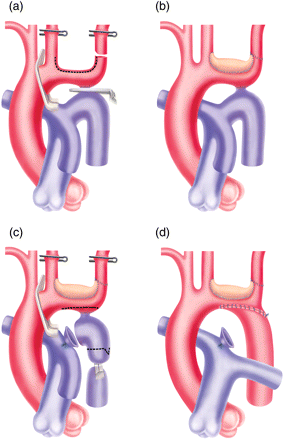 Technique of aortic arch enlargement, while maintaining ductal perfusion to lower torso (a and b). A classic resection and extended end-to-end anastomosis is then performed (c and d).