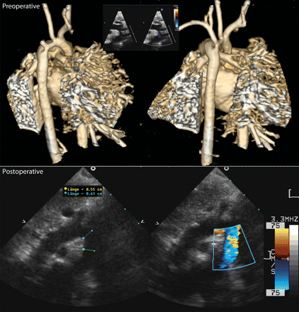 Preoperative three-dimensional magnetic resonance reconstruction of a severely hypoplastic ‘scooped out’ arch in a 10 day old 2.97 kg child, associated with a complete AV septal defect (upper panel); echo pictures nearly 6 months postoperatively showing a widely enlarged aortic arch (lower panel).